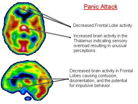 panic-attacks-facts